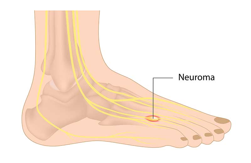mortons neuroma foot picture Injury Advice