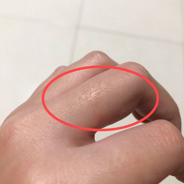 ring rash