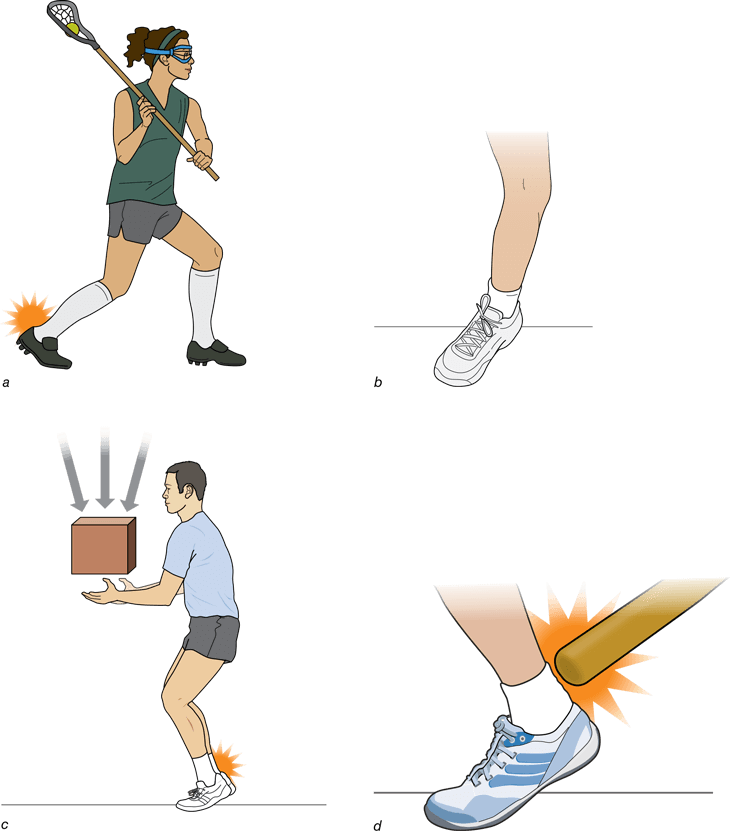 Figure 6.44 Mechanisms of calcaneal (Achilles) tendon rupture. (a) Rapid dorsiflexion of the ankle by a lacrosse player. (b) Cutting maneuver with rapid change of direction. (c) Catching a falling weight. (d) Blunt trauma to a taut tendon.