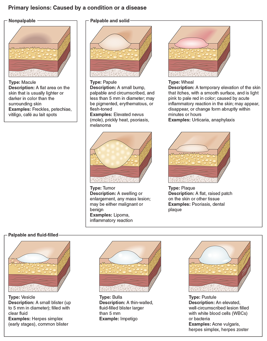 FIGURE 16.3 Common skin lesions.