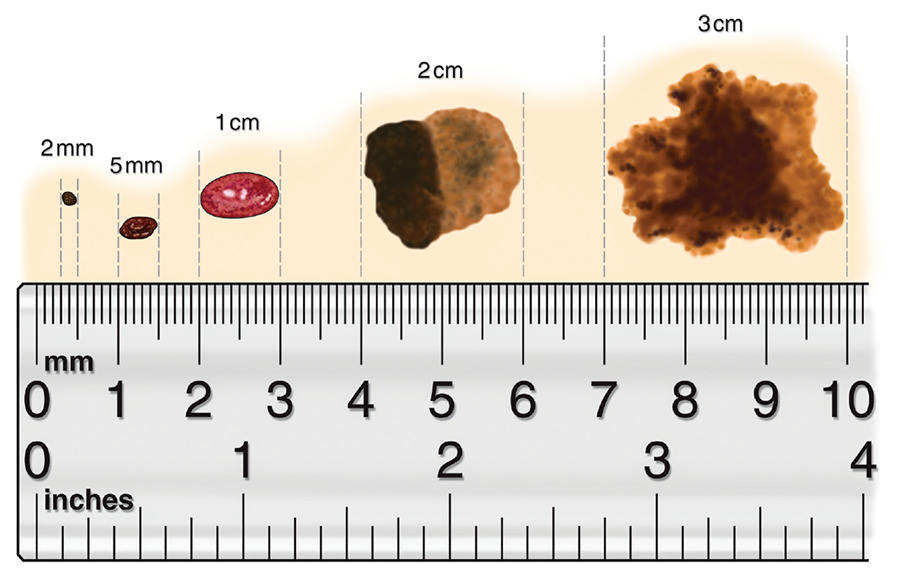 FIGURE 16.4 Comparison of lesion size.