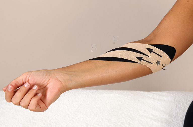 Figure 8.7 Second application of a smaller ‘Y’ strip across the area of pain.