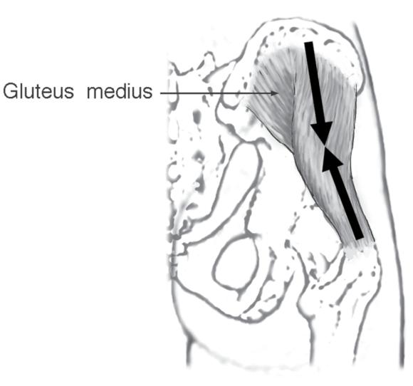 Approximate line of pull of the gluteus medius.