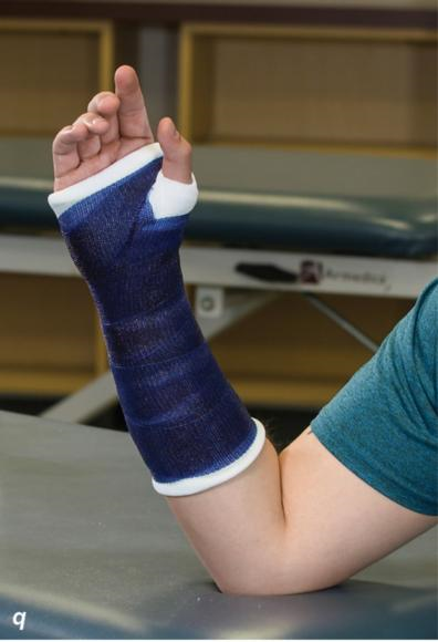 Applying and removing casts and splints – Human Kinetics