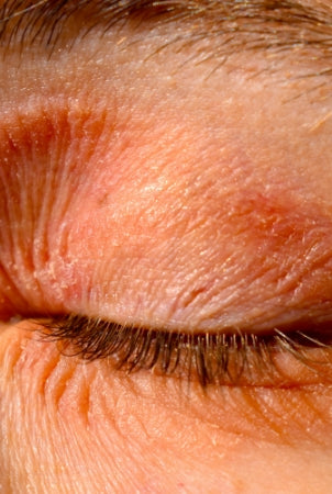 close-up of eyelid eczema