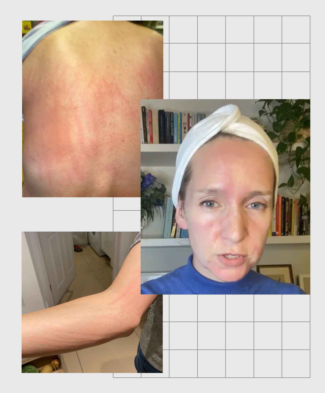  Urticaria on the skin 