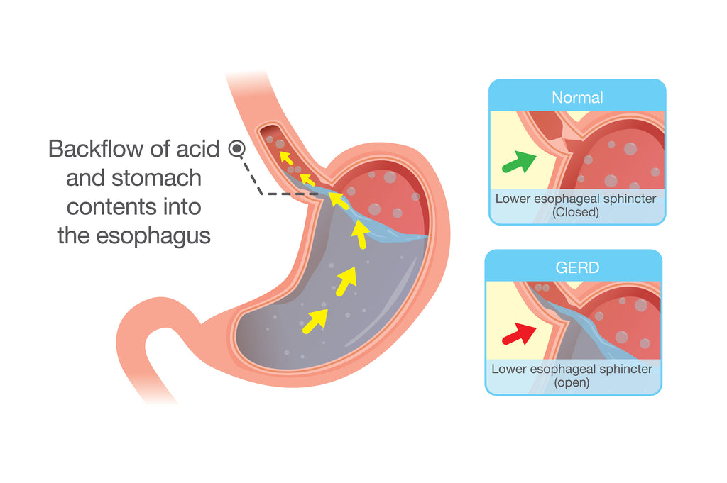 9 Acid Reflux Foods To Avoid - Swolverine