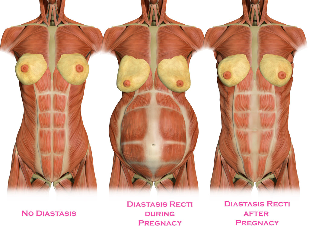 Diastasis Recti: What It Is And How To Fix It