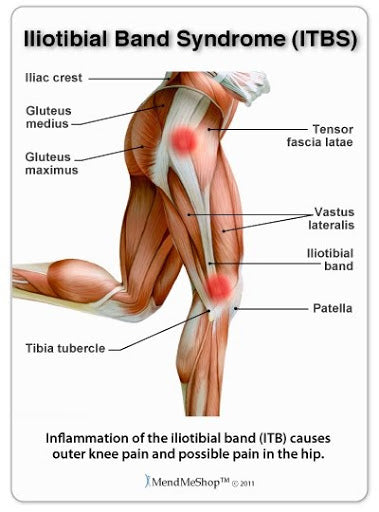 Tight IT Band Causes & How To Avoid IT Band Syndrome