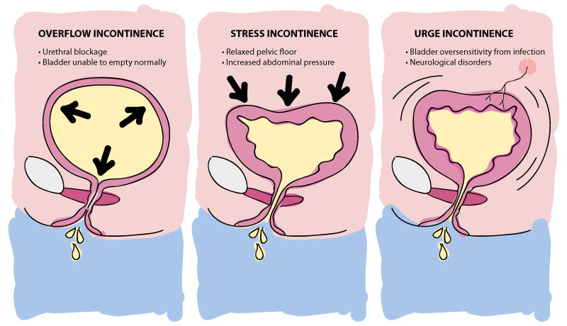 Types of Urinary Incontinence - Swolverine