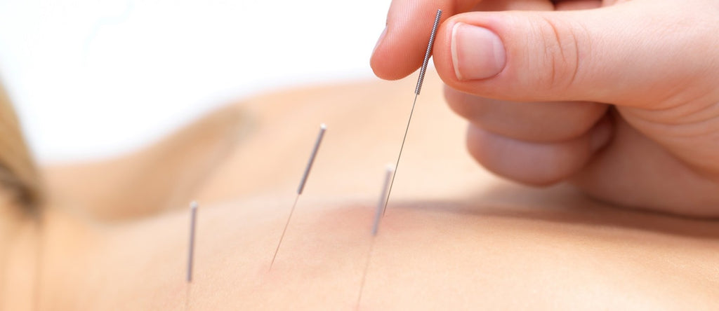 What Is Dry Needling - Swolverine