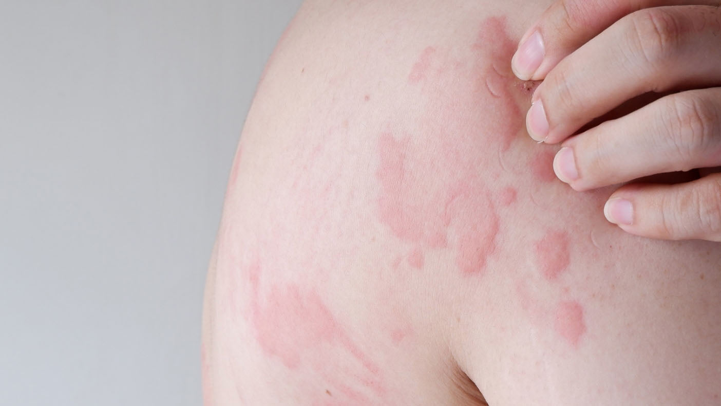 skin wheal causes