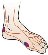 Diabetic Foot Care