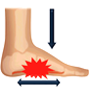 Flat Feet and Over-Pronation