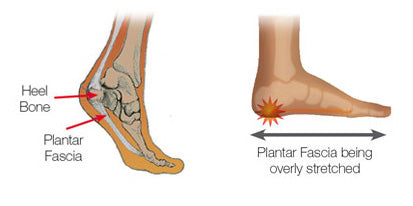 Heel Pain and Heel Spurs