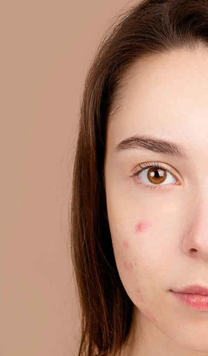 Close-up of a woman's face with acne spots on her cheek.