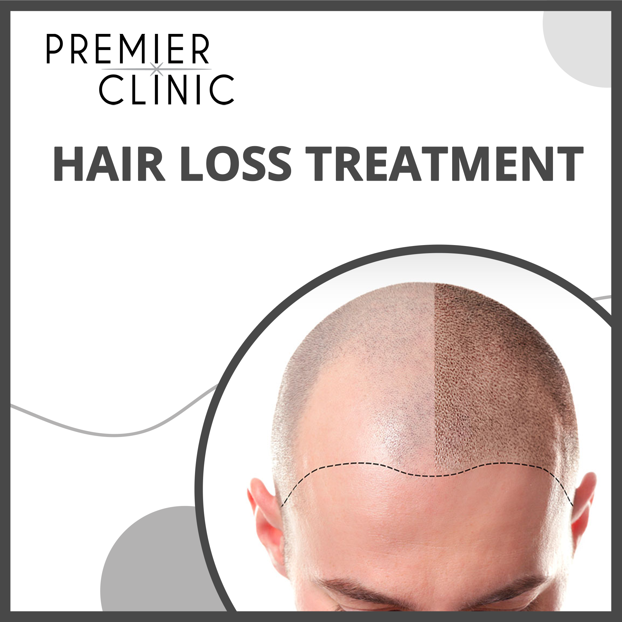 Premier Clinic: Hair Loss Treatment Package - 1 Pax - DoctorOnCall Online Pharmacy