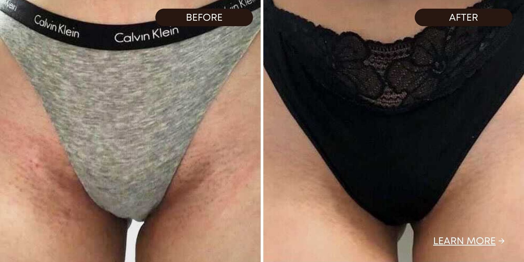Dark Spots on Bikini Line Before and After They Are Gone 