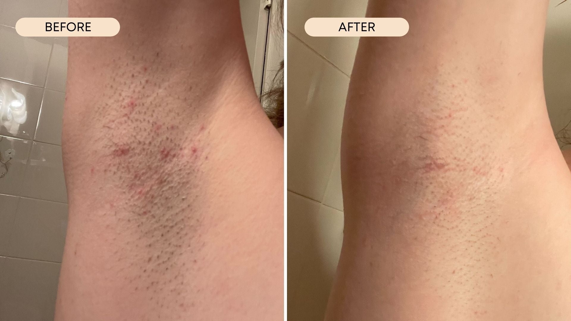 Official armpit ingrown hair before and after photos of it healing 
