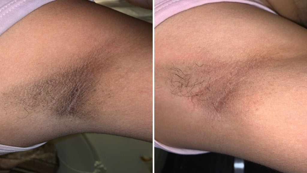 dark underarms on black women Acanthosis Nigricans