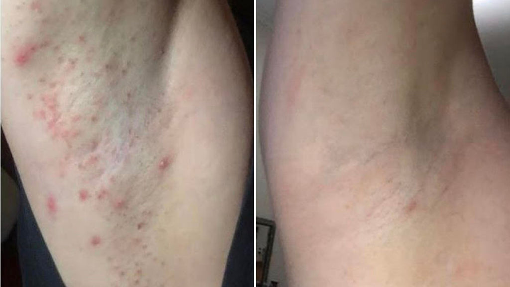 A heat rash causing itchy armpits 