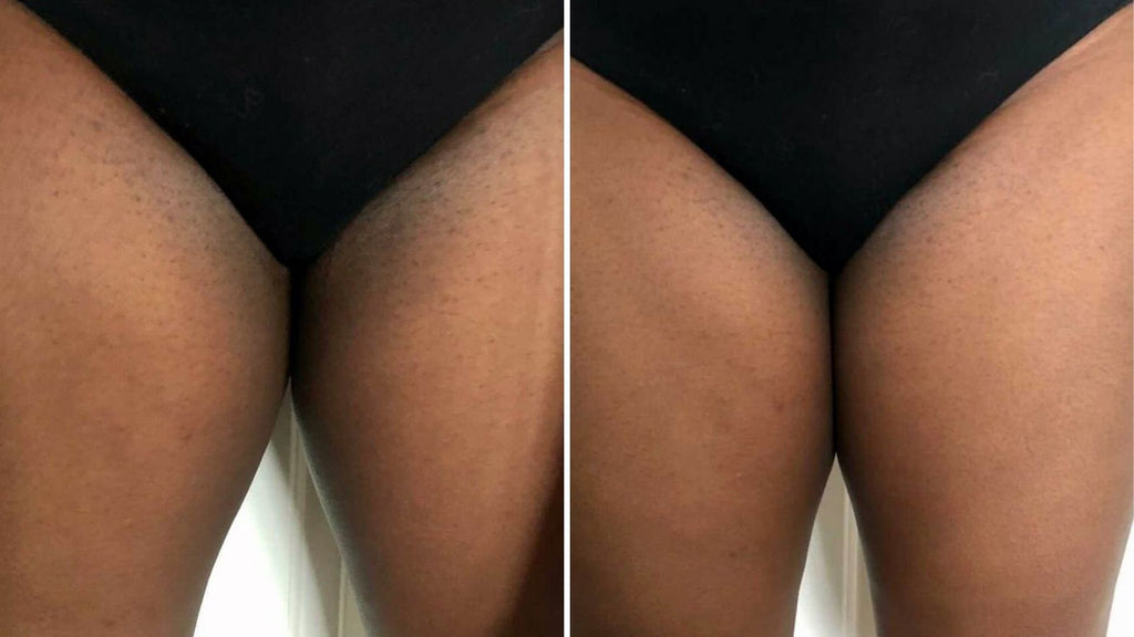 Swimwear model claims she was told to 'fix' the birthmark on her leg with  BLEACHING cream