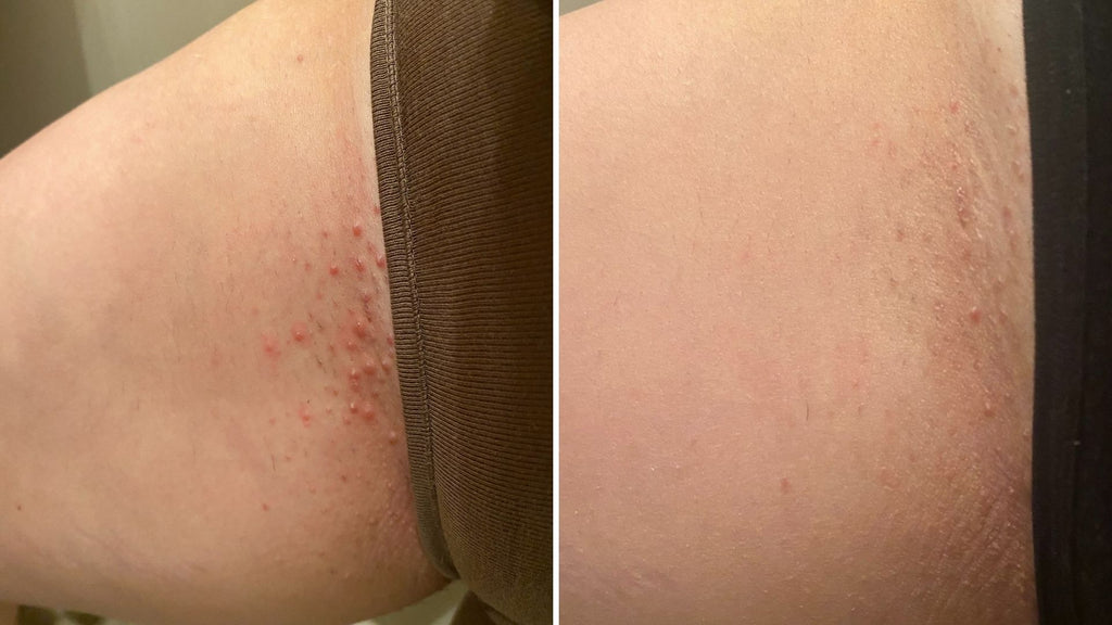 Razor burn on inner thigh of pubic region with a photo of after using a treatment oil