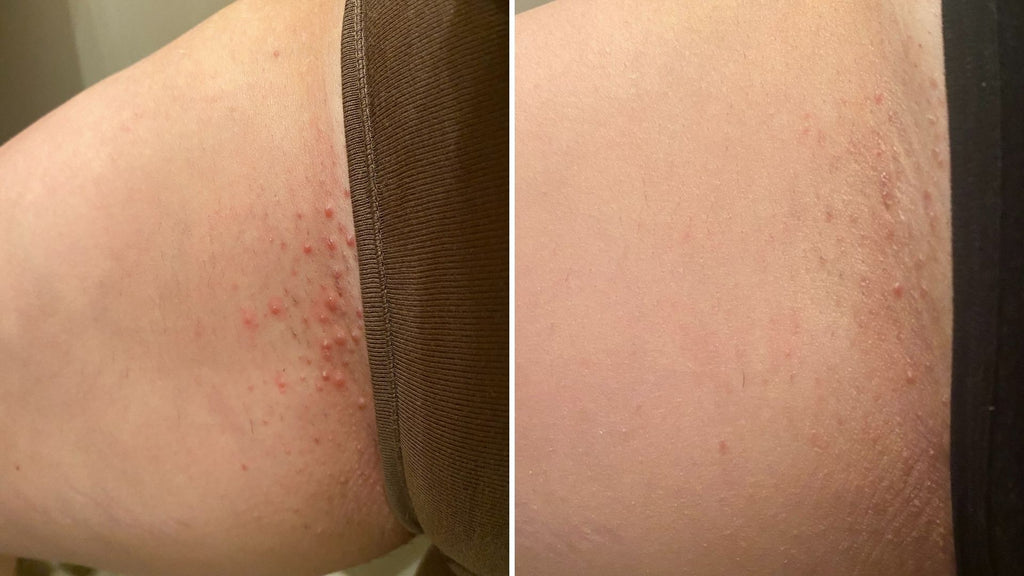 Red Itchy Bumps on Pubic Area PICTURE PLUS BLEEDING  Other Conditions  and General Health  Forums  Patient