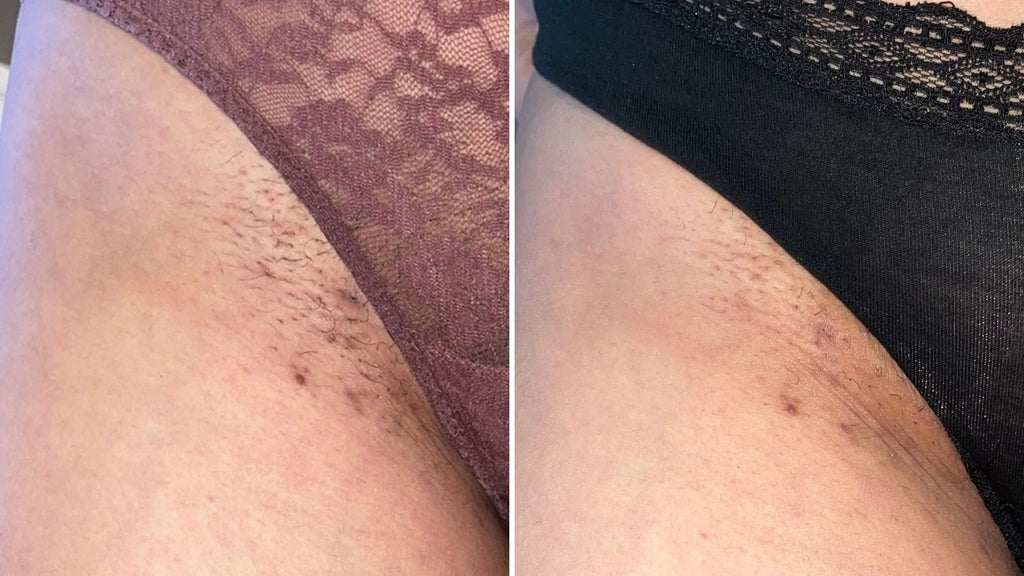 Razor burn on bikini line after shaving with underwear on