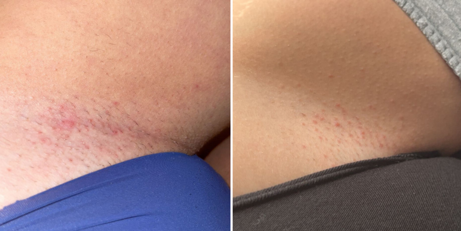 ingrown hair and razor bump results 