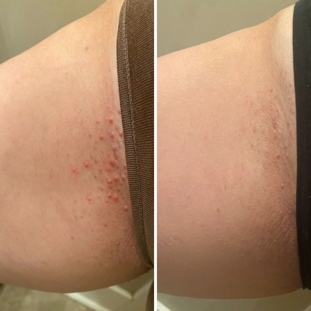 OT but desperate for help severe ingrown hairs on legs  September 2018  Babies  Forums  What to Expect