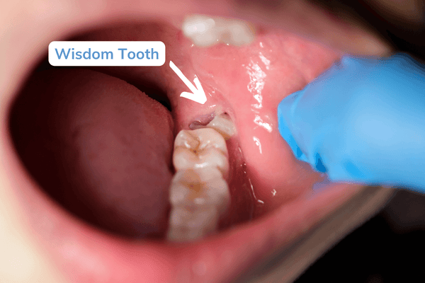 Wisdom tooth poking through gums, MABLE lifestyle Blog