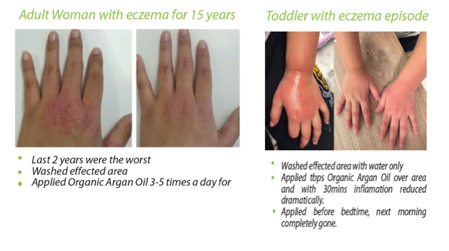 eczema treated with aynara argan oil