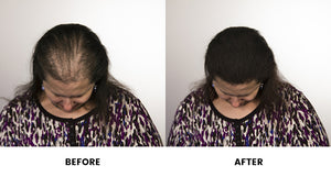 Alopecia Solutions Hair Fibers Thinning Hair Solutions Infinity