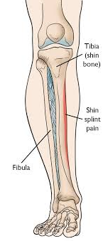 what are Shin Splints