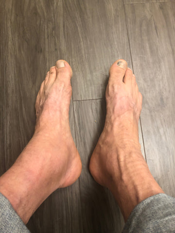 Swollen Ankle