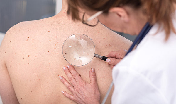 Doctor examining moles on patients back.