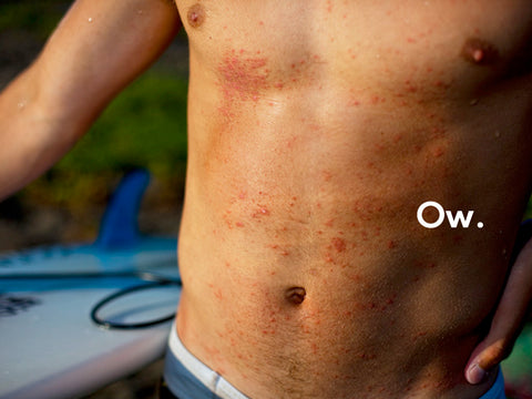 What is Surf Rash and How Can You Treat It? - SETT – SETT Surf