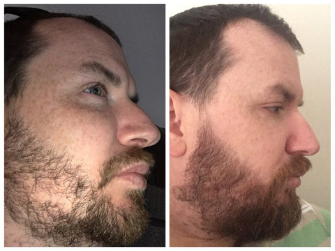 how to fill in patchy beard