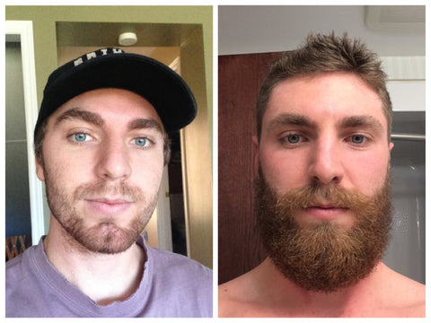 patchy beard before and after photo