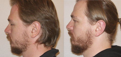 patchy beard before and after