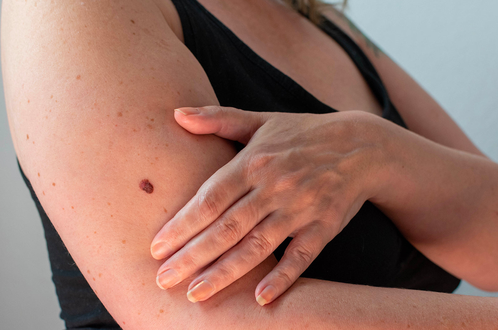 Cancerous Growth on a Woman's Arm