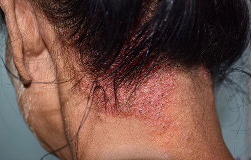 Scalp infections hair loss