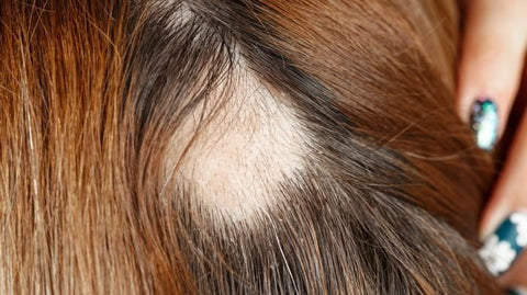 treatment for Alopecia Areata
