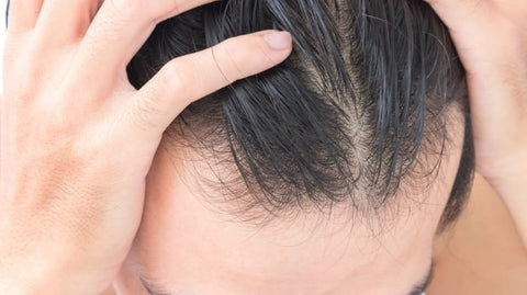 stop Hormonal hair loss