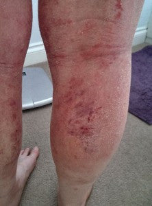 Eczema on legs