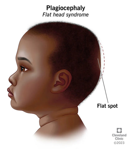 Positional Plagiocephaly diagram