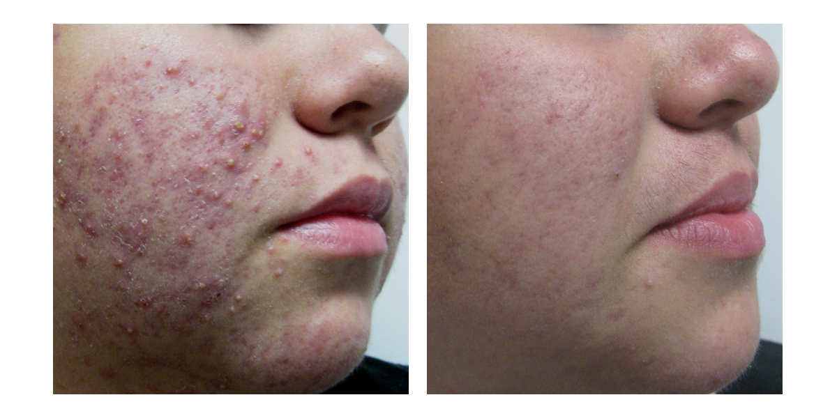 Cystic acne before and after photos