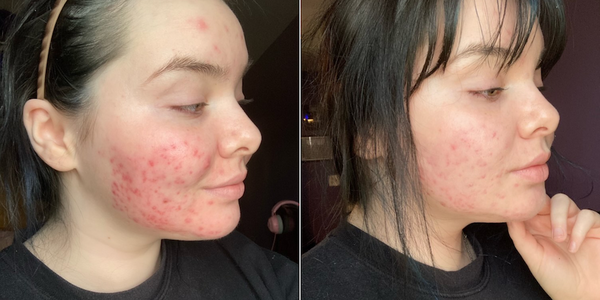 Before and after of @tv.skinjournal's acne journey 