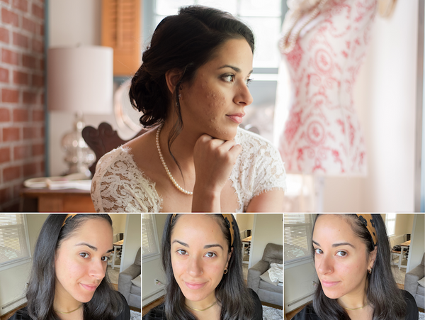 Before photo: bride with acne. After photo: clear skin.